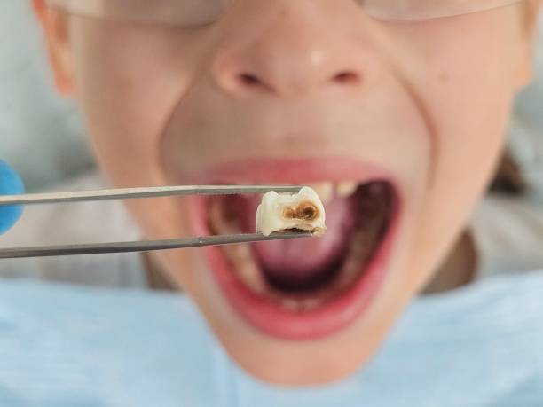 Best Chipped Tooth Repair Near Me  in Myers Corner, NY